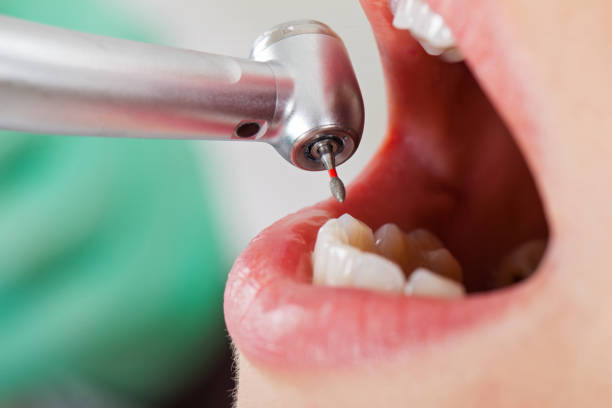 Best Emergency Dentist for Lost Fillings or Crowns in Socastee, SC